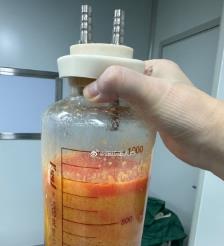 汉中水动力吸脂手术要做多久？